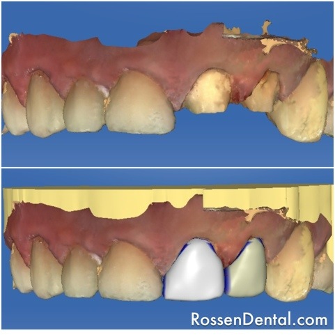 teeth cleaning