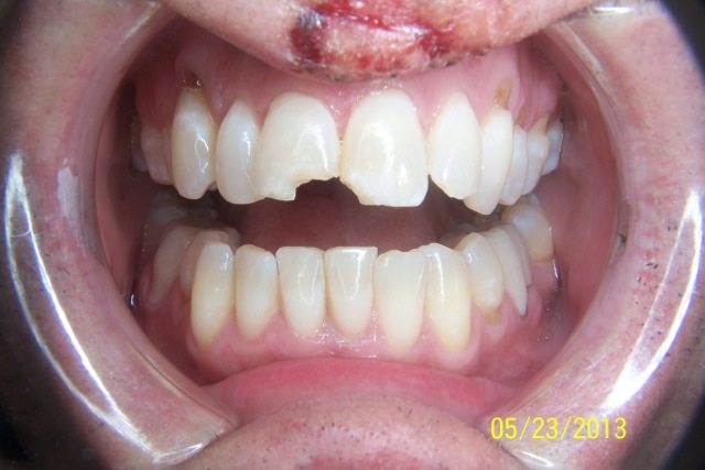 patient teeth before tooth treatment