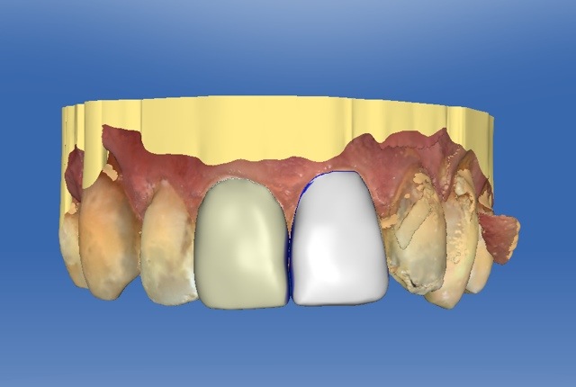 digital teeth image