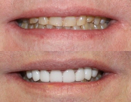 New Smile Before After