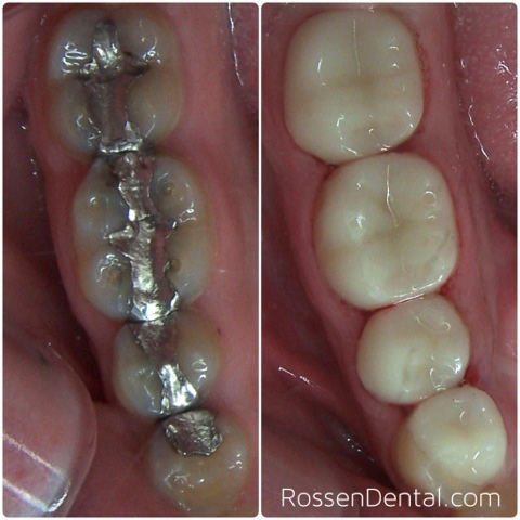 amalgam