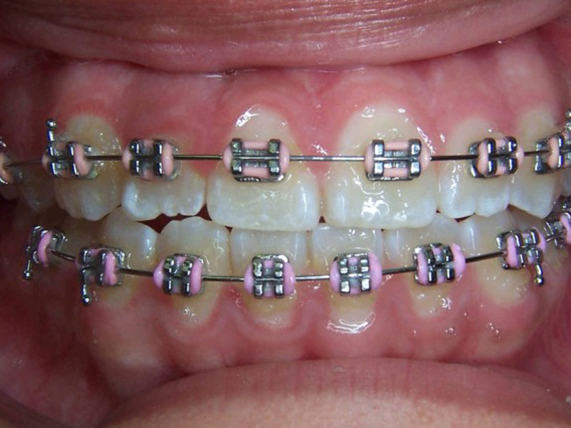 braces