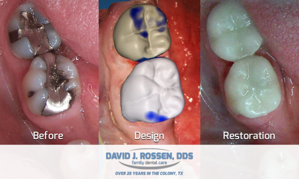 before and after cerec crowns