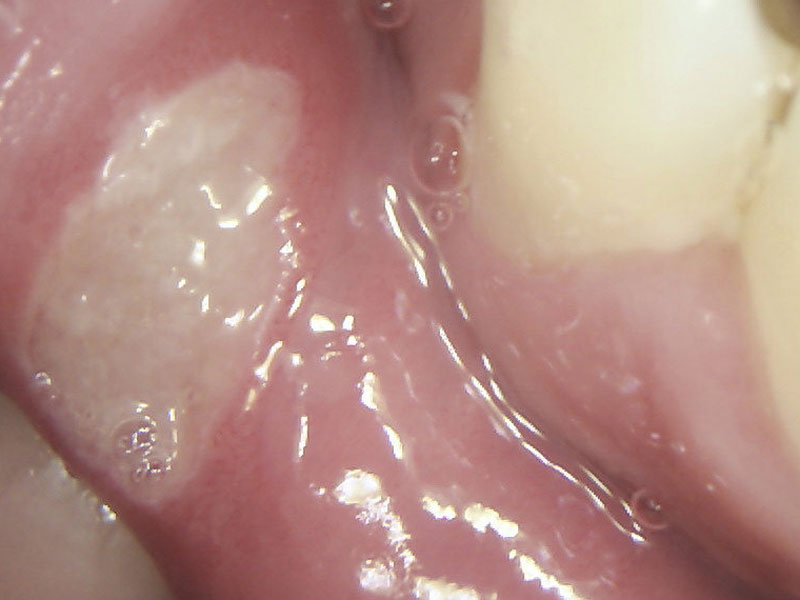 mouth ulcers