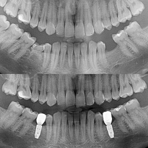 pano implant beforeafter