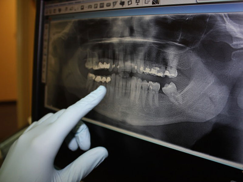 teeth X-ray